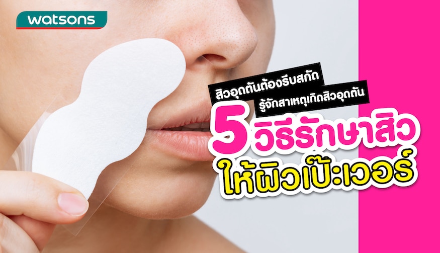 5 วิธีรักษาสิวอุดตัน ต้อนรับผิวใสง่าย ๆ ด้วยตัวเอง | Watsons Thailand