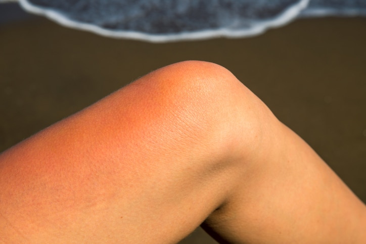 Woman leg with red sunburn skin on seaside background. Sunburned skin redness and irritation. Dangerous sun of tropical country. Summer vacation health problem. Sunscreen for sun burn prevention