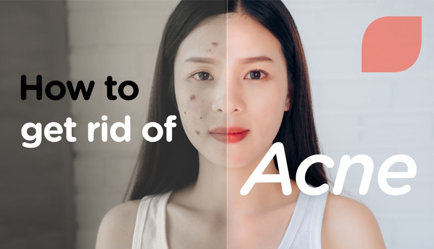 How to get rid of acne?