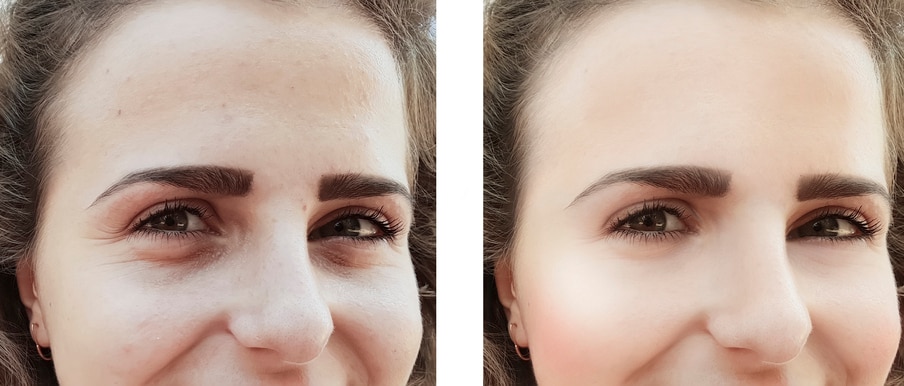 girl wrinkles eyes before and after procedures bags