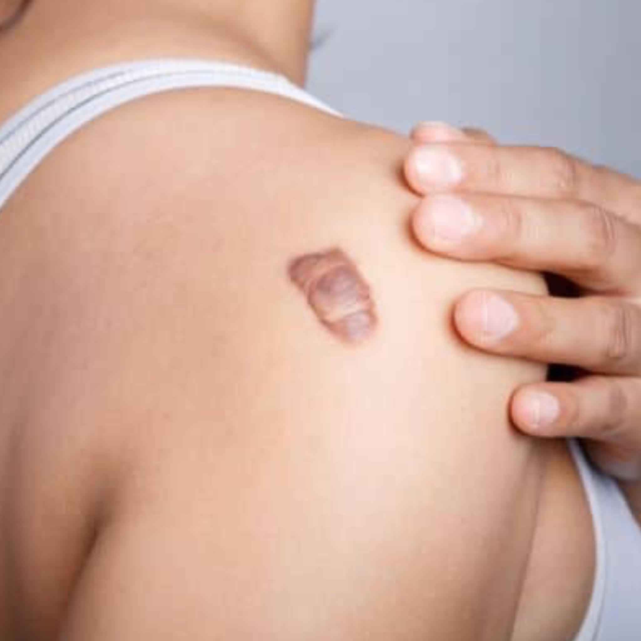 ยาทาแผลเป็นนูน ประเภทตามรูปแบบผลิตภัณฑ์ ซิลิโคนเจล แผ่นแปะ ครีม