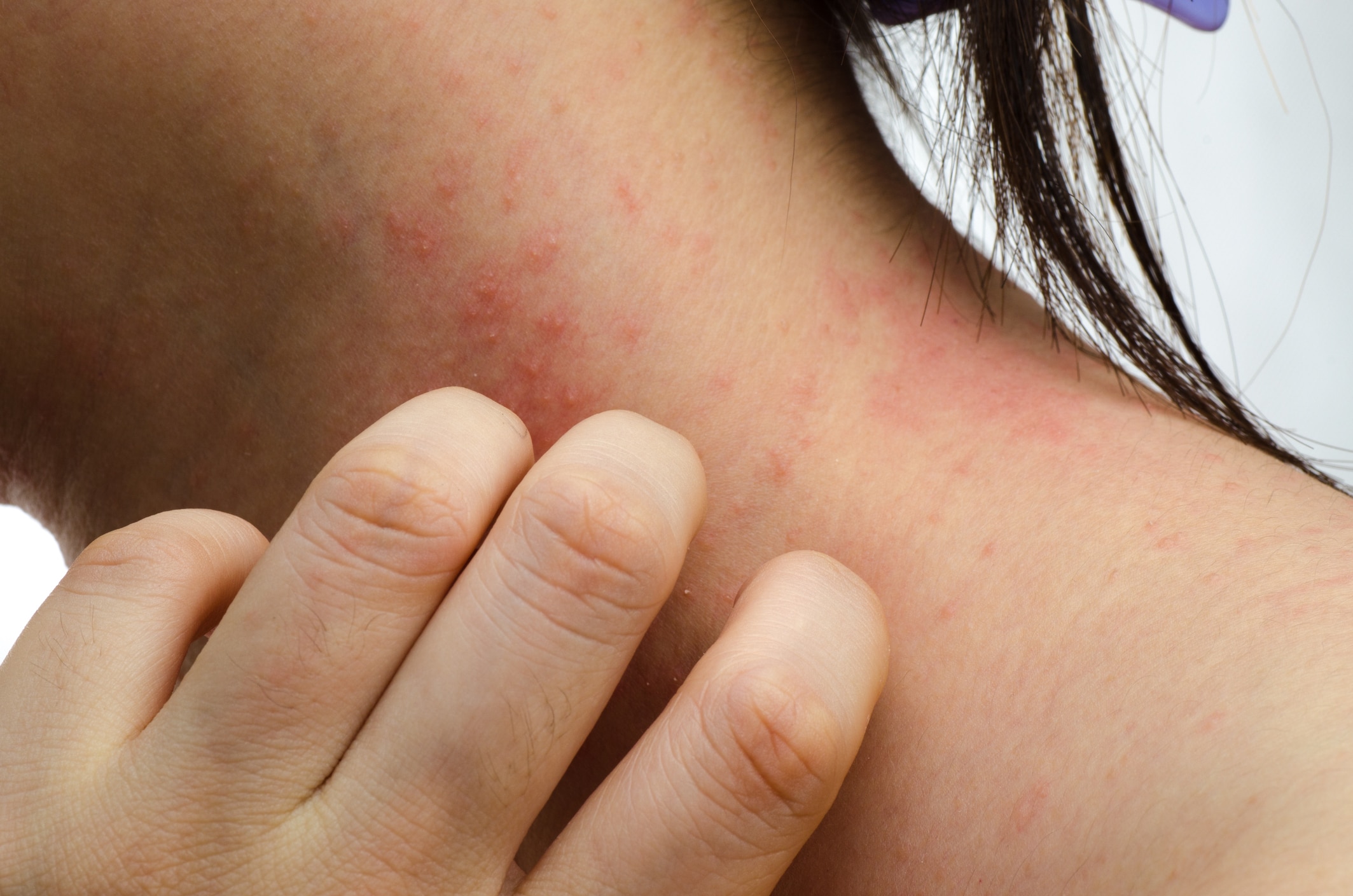 eczema skin on neck, symptoms of eczema