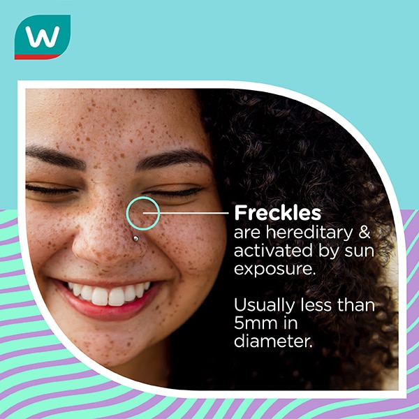 the causes and types of freckles