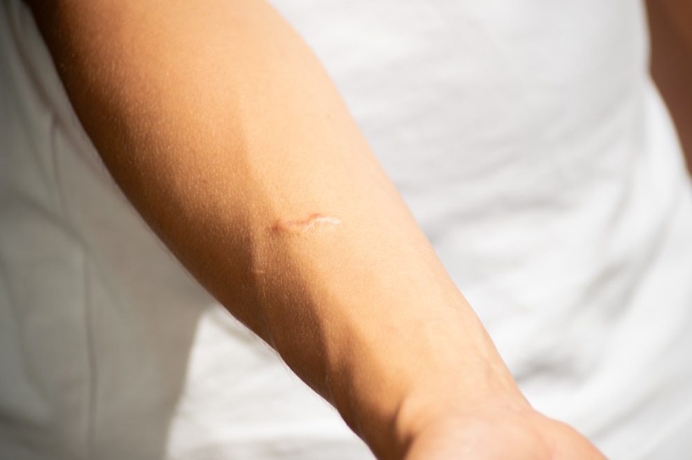 ยาทาแผลเป็นนูน และแผลเป็นนูน (คีลอยด์)