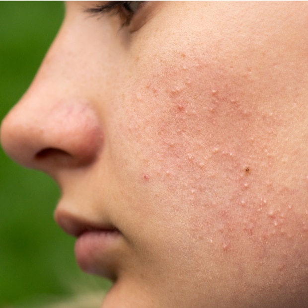 สิวอุดตันคืออะไร