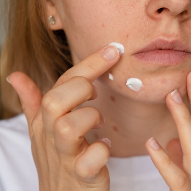 ใช้ยาละลายหัวสิวควรระวังอะไรบ้าง
